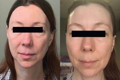 Woman treated with TempSure - Woman treated with TempSure.The results are after 1 treatment.