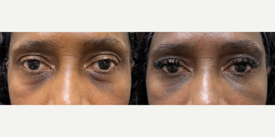 65-74 year old woman treated with SkinCeuticals, Dermal Fillers - Tear trough filler and daily use of SkinCeuticals Discoloration Defense serum to lower eyelid area