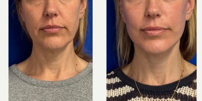 48 year old woman treated with Facelift under IV sedation. - 48 year old woman treated with Facelift under IV sedation.
