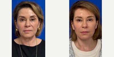 65-74 year old woman treated with Facelift, Eyelid Surgery - 65 year old woman treated with Facelift