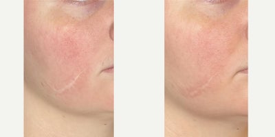 25 year old female's scar treated with SecretPRO RF microneedling and CO2 laser - Scar treated with SecretPRO radiofrequency microneedling and CO2 laser