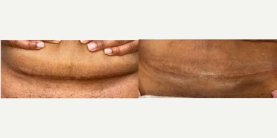 C-section Scarring Treated with Laser and Microneedling - 3 sessions of SecretPRO radiofrequency microneedling and CO2 laser for cesarean section scar resurfacing to minimize the appearance of the scar and discoloration