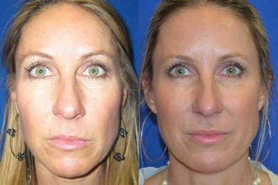 Sculptra Aesthetic - This patient came in wanting to discuss natural-looking treatments for facial rejuvenation. After consulting with Dr. Ho about options for collagen stimulation the patient elected to have a sculptra treatment series.