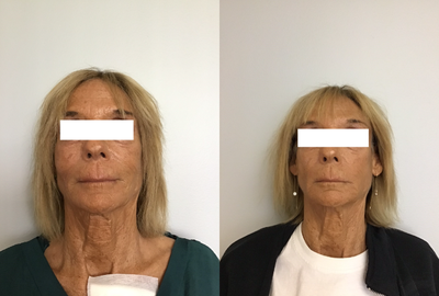 55-64 year old woman treated with Laser Genesis - Biorevitalization, dysport, Bellafill and Laser Genesis