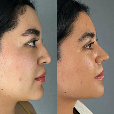 Rhinoplasty - PRIMARY RHINOPLASTY