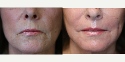 Lip Lift and Laser Resurfacing - Filler could no longer address her lips, so a lip lift and laser resurfacing for her lip lines were combined.