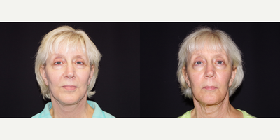 55-64 year old woman treated with ArteFill - 64 year old female received 1 syringe of Bellafill to the left cheek; photos depict the patient's results 5 months post-treatment.