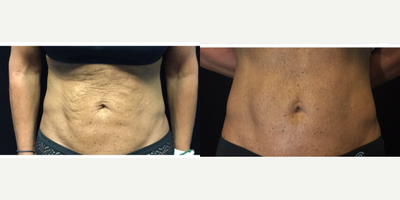 35-44 year old woman treated with Morpheus8 - Patient had one Morpheus8 Body treatment to abdomen.