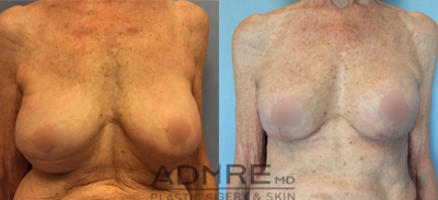 74 yo w/ Breast Implant Revision - Change to smaller implants, Re-create breast fold, Mastopexies - 74 yo woman3 prior breast surgeries w/ another physicianComplains of: loss IMF definition, breasts too large, implants too low and off to sidesExchanged out old 300cc silicone, moderate profile implantsPlaced Inspira SSF 200cc BilaterallyRe-created IMFMastopexies