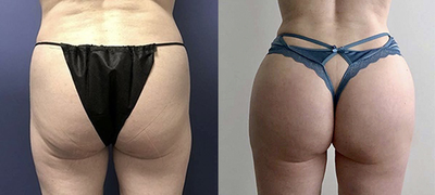 Woman treated with Hip Augmentation - Woman treated with Hip Augmentation
