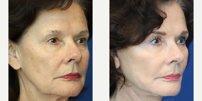 Woman treated with Facelift - Woman treated with Facelift
