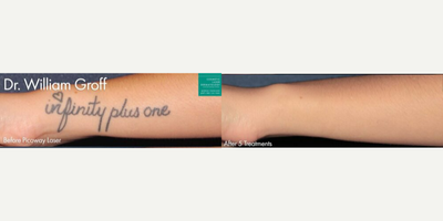 25-34 year old woman treated with PicoWay - PicoWay laser used to remove unwanted tattoo from the leg of a female patient by Dr. Groff.