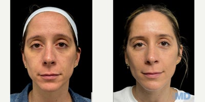35-44 year old woman treated with NeoGen Plasma - This lovely patient is experiencing improved results -- shown at 30 days post NeoGen treatment.