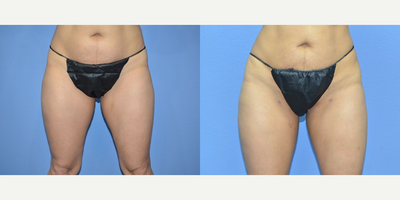 46 year old woman treated with BodyTite, Liposuction - 46 year old woman treated with BodyTite, Liposuction