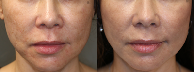Smoothbeam Laser - Laser resurfacing for acne scars.