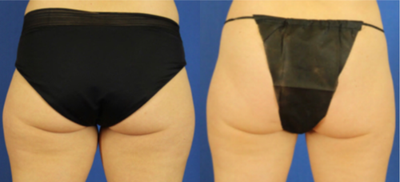 35-44 year old feman treated with Liposuction - Liposuction of flanks and thighs.