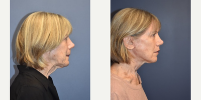 Woman treated with Facelift - Woman treated with Facelift, Neck Lift