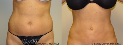 25-34 year old woman treated with Velashape - This patient underwent liposuction of the abdomen and flanks with Newport Beach Plastic Surgeon Dr. Sanjay Grover. Post-surgery, she was treated with VelaShape and Refirme, both skin tightening treatments.