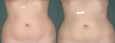 Liposonix - 
	This patient underwent treatment with Liposonix, a non invasive method of shrinking subcutaneous fat using high frequency focused ultrasound. After a single treatment, lasting about an hour, the patient gradually lost fat over the abdominal area over a period of 12 weeks after treatment with Liposonix. Toronto patients enrolled in a recent study of Liposonix had a satisfaction rate of 90% with the treatment. Treatment with Liposonix involves no incision of any kind, and no significant downtime. The front and lateral views of this patient demonstrate a typical degree of fat loss, the average being 2.8cm reduction in waste measurement which translates into one pant or skirt size. Liposonix is not for overweight individuals but can be considered in patients like this one, who are close to their ideal body weight and have good skin tone.
