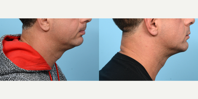 35-44 year old man treated with Chin Surgery - In order to achieve the chiseled jawline of this patient's dreams, Dr. Wise performed a combination of chin implant and submental liposuction procedures.