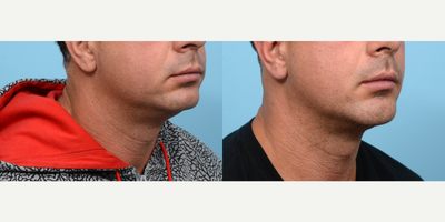 35-44 year old man treated with Chin Surgery - In order to achieve the chiseled jawline of this patient's dreams, Dr. Wise performed a combination of chin implant and submental liposuction procedures.