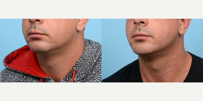 35-44 year old man treated with Chin Surgery - In order to achieve the chiseled jawline of this patient's dreams, Dr. Wise performed a combination of chin implant and submental liposuction procedures.