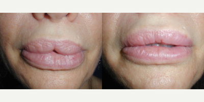 Lip Reduction - Lip Reduction