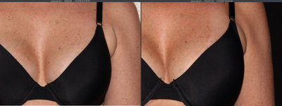 45-54 year old woman treated with CoolMini - 51 year old female treated for armpit fat with Cool Mini.