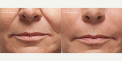 Radiesse Nasolabial Folds - This female patient was concerned with her deep nasolabiol folds, as a result of her cheeks losing collagen and elastin. Dr. Rivkin injected Raddiese to stimulate collagen growth. As a result, the patient's nasolabial folds diminished to give her a more youthful appearance.