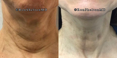 65-74 year old woman treated with Ultherapy, Sofwave, Neck Lift, Skin Tightening - 69 year old woman treated with Sofwave and Ultherapy to reduce neck wrinkles