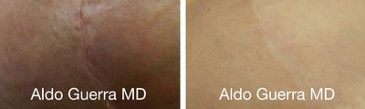 25-34 year old woman treated with Embrace Scar Therapy - Before and after embrace Active Scar Defense treatments for the vertical breast lift incision. Results shown at 1 year 2 months.