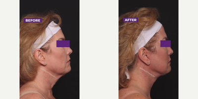 25-34 year old woman treated with Facelift, Neck Lift - 25-34 year old woman treated with Facelift, Neck Lift2 months post-op