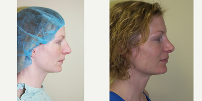 35-44 year old woman treated with Rhinoplasty - Rhinoplasty