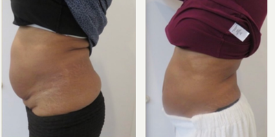 45-54 year old woman treated with Velashape - Patient receiving a number of treatment services, here at About Face Centers.