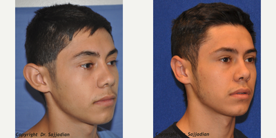 Ear Surgery - Ear Surgery