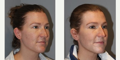 35-44 year old woman treated with Vampire Facial - Vampire Facial35 yo, F, 53, 120lbs, G1P1