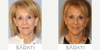 65-74 year old woman treated with Facelift Revision - 65-74 year old woman treated with Facelift Revision