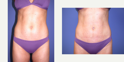 35-44 year old woman treated with Smart Lipo - 39 year old female who underwent Smartlipo of the abdomen