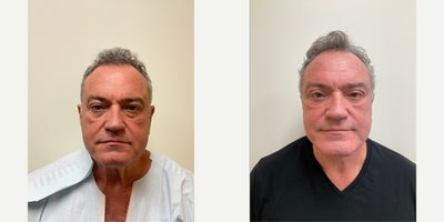 Man treated with Eyelid Surgery, Facelift - 3 months post facelift, upper, and lower Blepharoplasty