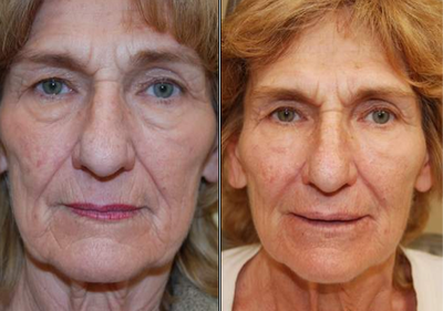 Non-surgical face lift with Silikon-1000 - This woman from Rockaway, NJ requested facial rejuvenation around a year ago, but she did not want to undergo a facelift or a laser-resurfacing procedure. The after pictures demonstrate less wrinkles, and folds, along with restoration of facial volume. Liquid Injectable Filler (Silikon-1000) was used on several occasions to the lower eyelid grooves, cheeks, laugh lines, lips, and many wrinkles around her mouth. These results without makeup are permanent, and completely natural.