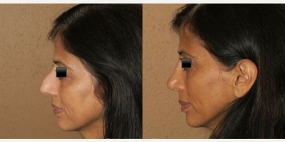 Woman treated with Rhinoplasty - Woman treated with Rhinoplasty