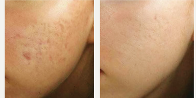 25-34 year old woman treated with Microchanneling - microchanneling for ice pick scarring- after 4 treatments 1 month apart