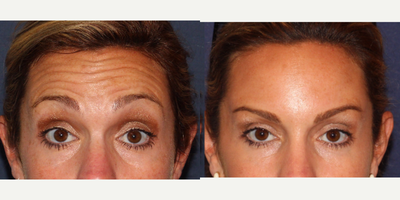 25-34 year old woman treated with Dysport - Woman treated with Dysport injections for fine lines and wrinkles to the forehead.