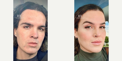 Transgender woman treated with Chin Liposuction - Transgender woman treated with Facial Feminization Surgery through Hairline Advancement, Type 3 Brow Bone Reconstruction, Brow Lift, Eyelid Surgery through upper blepharoplasty, Submalar implants, Jaw Reduction, Genioplasty, Tracheal Shave, Chin Liposuction, Neck Lift, and Open Rhinoplasty. She is shown before and 3 months post op.
