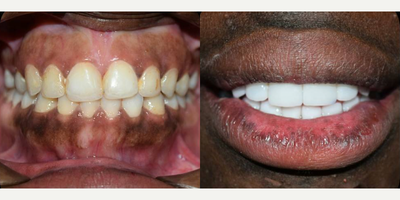 Man treated with Porcelain Veneers, Dental Implants - Man treated with Porcelain Veneers, Dental Implants