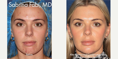 25-34 year old woman treated with Clear and Brilliant - Combination of Clear+Brilliant laser, IPL, and Vbeam, along with injectables, used to clear the complexion and refresh the appearance of a female patient.