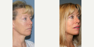 Woman treated with Facelift - Woman treated with Facelift