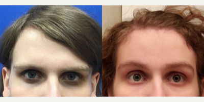 Transgender woman treated with Forehead Reduction - Transgender woman treated with Forehead Reduction