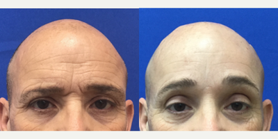 Transgender woman treated with Forehead Reduction - Transgender woman treated with Forehead Reduction