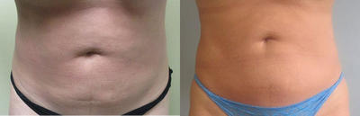 35-44 year old woman treated with i-Lipo - 35-44 year old woman treated with i-Lipo